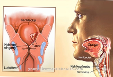 Throat cancer