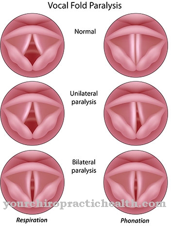 Larynx lammelse