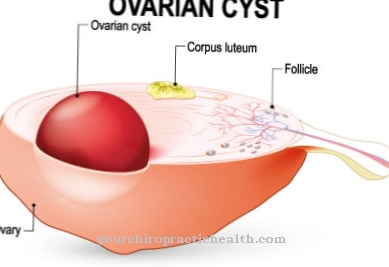 Germ cell tumor