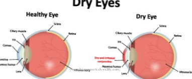 Keratoconjunctivitis sicca