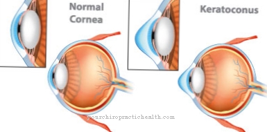 keratoconus