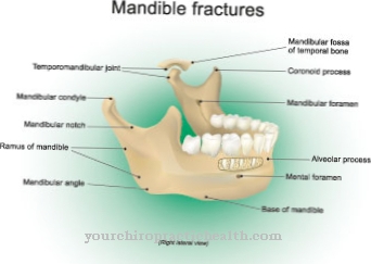 Broken jaw