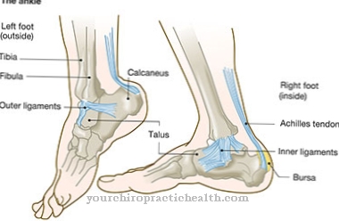 Clubfoot