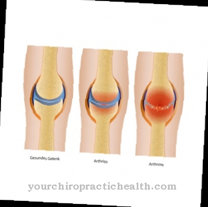 A térd osteoarthritis