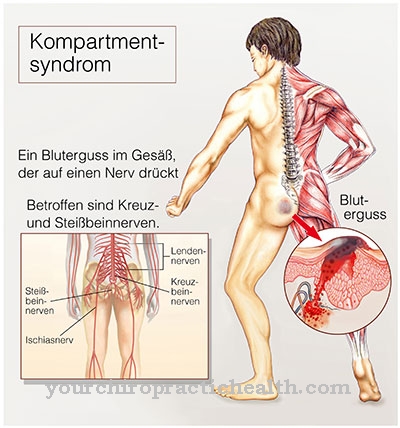 Compartment syndrome