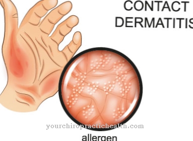 Alergi kontak (dermatitis kontak)