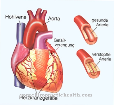 Coronary heart disease