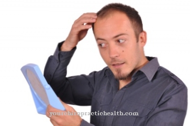 Circular hair loss