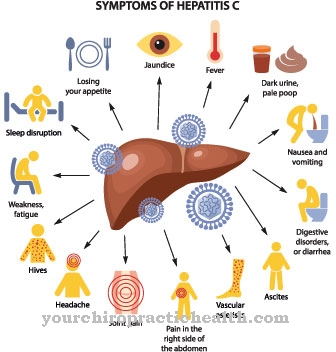 Cryoglobulinemie