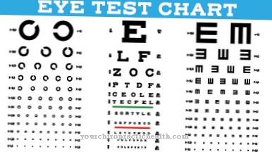 Nearsightedness (myopia)