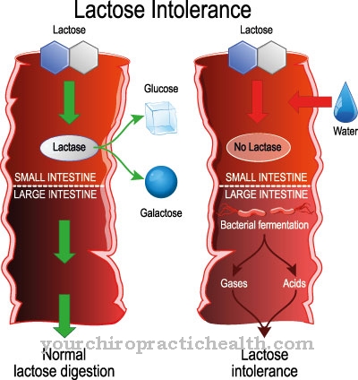 Laktoz intoleransı (süt şekeri intoleransı)