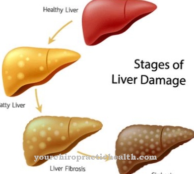 Liver fibrosis