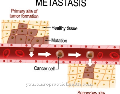 Aknu metastāzes