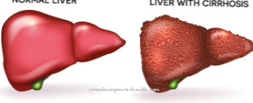 Cirrhosis of the liver