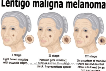 Lentigo maligna