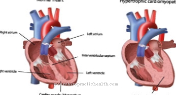 Linker ventrikel hypertrofie