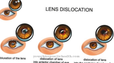 Lens dislocation