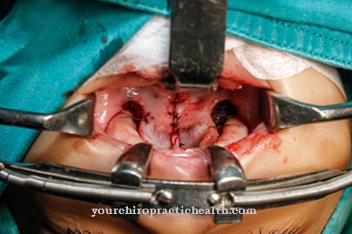 Cleft lip and palate (Cheilognathopalatoschisis)