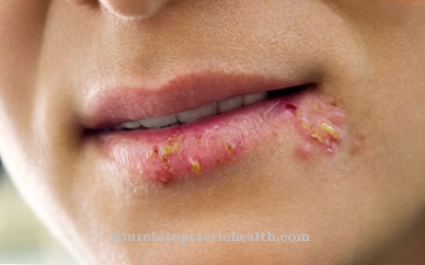 Cold sores (herpes labialis)