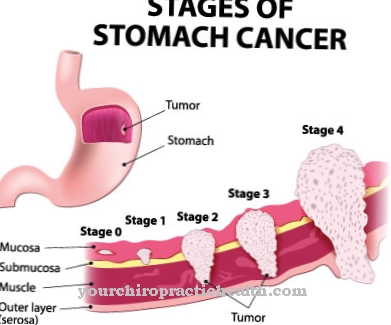 Cancer la stomac