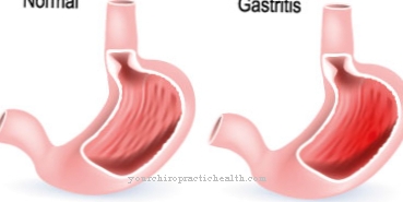 Inflammation of the lining of the stomach (gastritis)