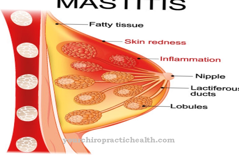 Mastitis puerperal (inflamación de la mama durante la lactancia)