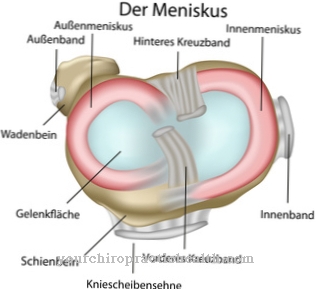 Meniscal tear