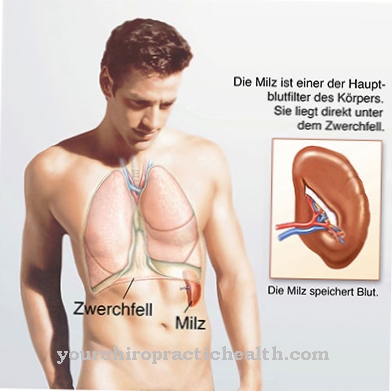 Splenic infarction