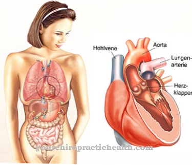 Mitral valve prolapse syndrome