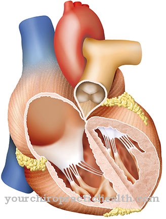 Mitral stenosis