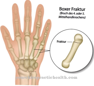 Metacarpal fracture