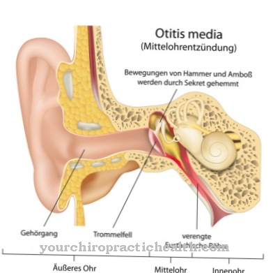 Otitis media