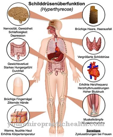 Graves disease (Graves disease)