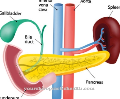 Gaucher disease (Gaucher syndrome)