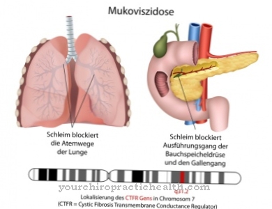 Cystisk fibrose