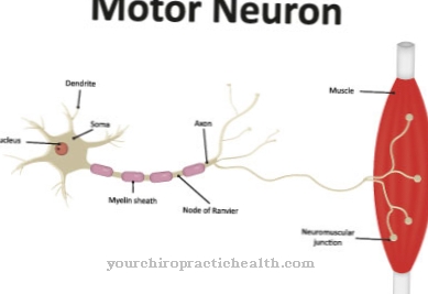 Neuropatia motoria multifocale