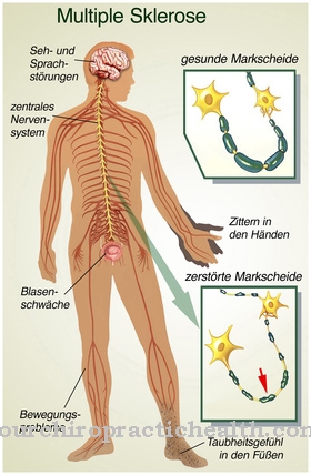 multiple sclerosis