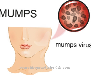 mumps