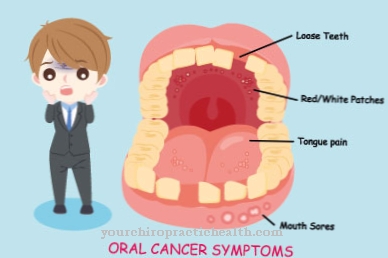 Oral cancer