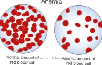 Myelodysplastic Syndrome