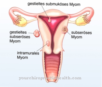 Fibroid (tumor rahim)