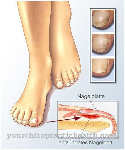 Inflammation of the nail bed