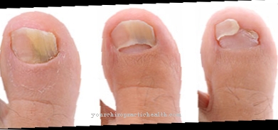 Nail fungus