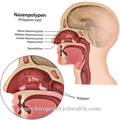 Nasal polyps