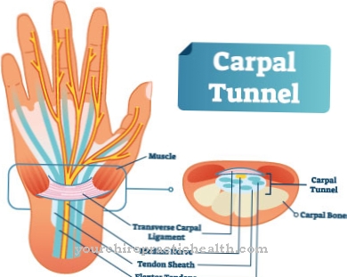 Nerve compression syndrome