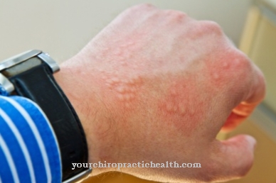 Hives (urticaria)