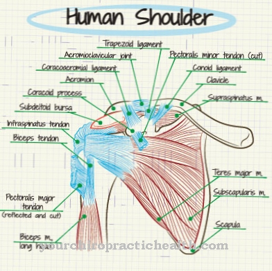 Neuralgic shoulder amyotrophy