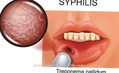 Neirosifilis