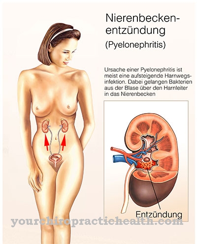 Keradangan pelvis