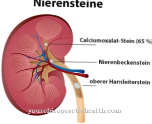 Kidney stones